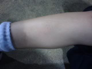 Bruised leg