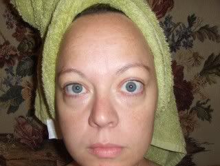 Dysthyroid Eye Disease